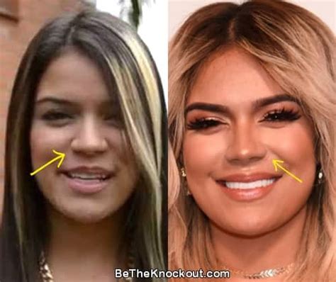 Karol G: Before and After Plastic Surgery (2 of 3)